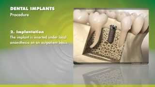 Straumann Dental Implants  Tricare [upl. by Nylteak]