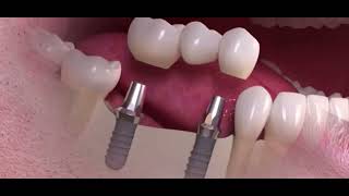 Le BRIDGE sur IMPLANTS dentaires  le pont dentaire sur implants [upl. by Alpert687]