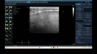 IQ 305 LIVER ULTRASOUND ECHOPAC ANALYSIS HEPATOMA [upl. by Sabu624]