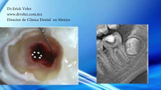 Endodoncia Molar Inferior Clinica Dental Velez [upl. by Aved]