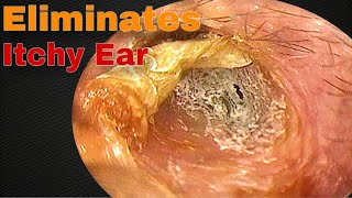 The Itching Stopped after Removing Earwax  Doctor Anh [upl. by Adehsar]