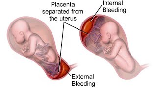 What is antepartum haemorrhage😷How to manage APHdrsaminakhurshidgynaecolog4661 [upl. by Ennyleuqcaj]