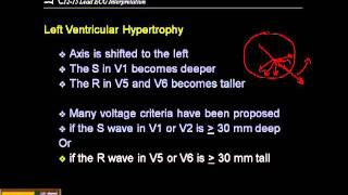 1215 Lead ECG Ventricular Hypertrophy [upl. by Anatnom]