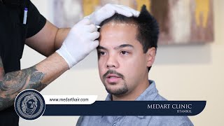 Hair Transplant Turkey  Medart Hair Clinic Istanbul [upl. by Yahsan]