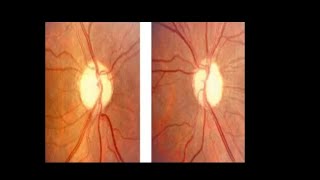 Optic atrophy Primary Secondary glaucomatous optic atrophy AnterogradeRetrograde AION RNFL [upl. by Elitnahc]