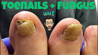 HOW TO CUT THICK TOENAILS WITH FUNGUS [upl. by Aerdnaxela]