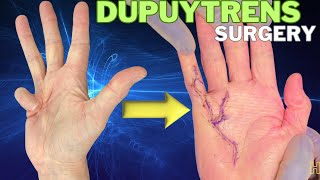 Dupuytren vikings hand correction surgery before and after [upl. by Oneill322]