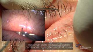 Blefaroplastia de las Glandulas de Meibomio [upl. by Aleyak448]