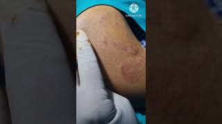 Best micropigmentation camouflage after vitiligo melanocyte transplant treatment Call 9700020802 [upl. by Ahtanaram]