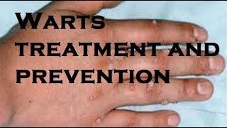 Warts treatment and prevention [upl. by Rana]