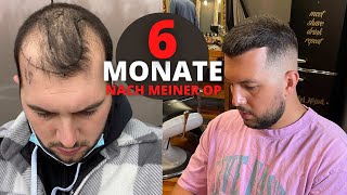 Haartransplantation Vorher Nachher  6 Monate nach der OP [upl. by Obocaj265]