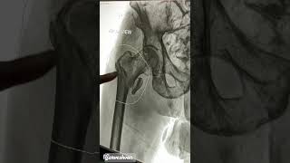 Hip fracture  hip surgery hip replacement [upl. by Gersham253]