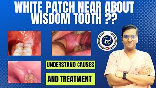 Dr Rudra Mohan  quotShould I be worried for a white patch behind and around my wisdom tooth [upl. by Graniela]