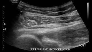 Shoulder Ultrasound Status Post Hydrodilation of Adhesive Capsulitis Part 2 [upl. by Appel706]