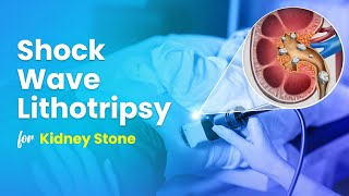 Shock Wave Lithotripsy ESWL for Kidney Stone Treatment  3D Guide [upl. by Archer831]