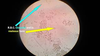 Stool analysisLab diagnosis of dysentery bacillary dysentery [upl. by Drandell]