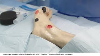 Application tips 3M™ VAC® Dressing Application Bridging Technique on Foot Wound [upl. by Trovillion617]