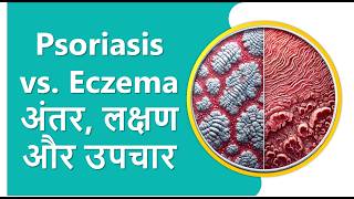 Psoriasis vs Eczema  Key Differences Symptoms and Treatments Explained [upl. by Thea180]