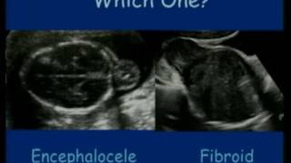 Ultrasound Congenital Anomalies  fetal medicine  fetus [upl. by Naitsyrk]