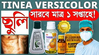 Tinea Versicolor TreatmentPityriasis Versicolor Treatmentছুলি দূর করার উপায় [upl. by Eenobe]