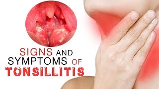 9 Signs and Symptoms of Tonsillitis [upl. by Pulchia]