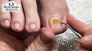 Big Toenail Fix at Home nails satisfying [upl. by Nojram928]