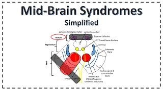 MidBrain Syndromes  Weber Syndrome  Benedikt Syndrome  Parinauds Syndrome [upl. by Ihcehcu]