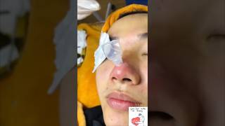 Inflamed Acne on Nose shorts pimple acne acneking [upl. by Lay]