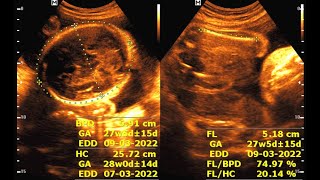 Sonographic evaluation at 37 weeks of pregnancy [upl. by Teemus735]