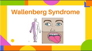 Wallenberg Syndrome  Lateral Medullary Syndrome  PhysiotherapyKnowledge [upl. by Aiset]