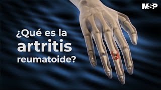 Artritis Reumatoide  ExclusivoMSP [upl. by Bow]