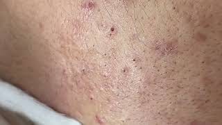 Blackheads are great P2  Acne Treatment Mai Ngoc [upl. by Neerac]