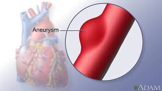 Mesenteric Artery Ischemia [upl. by Llenrac503]