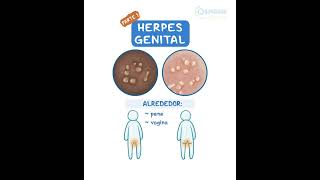 Herpes Genital [upl. by Richers]