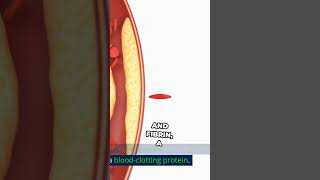 Atherosclerosis Causes and Solutions [upl. by Valry]