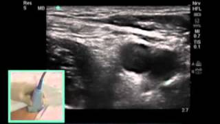 How To FEMORAL NERVE BLOCK  Dr Auyong Scanning Technique Video [upl. by Reinar]