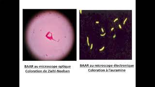 06Tuberculose extrapulmonaire TEP Pr Yahaoui Beni Messousse  Pneumo [upl. by Winwaloe]