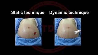 Ultrasonography Guided Paracentesis [upl. by Atiuqes]