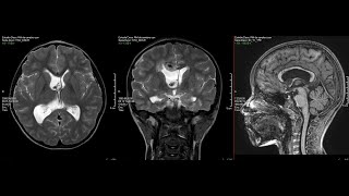 Tumor Ventricular Oligodendroglioma [upl. by Garnett971]