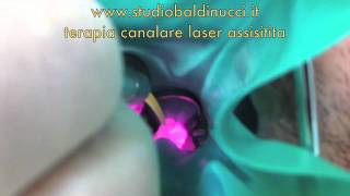 Terapia canalare laser assistitam4v [upl. by Matthieu]