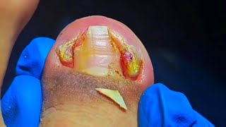 The WORST Case of Infected Ingrown Toenail Youve Ever Seen [upl. by Corwin]