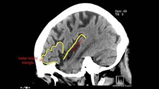 Introduction to Brain Surface Anatomy [upl. by Deane141]