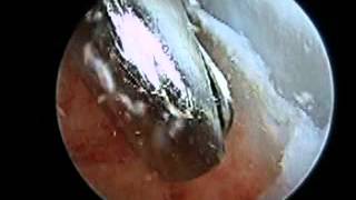 Posterior Arthroscopy with Haglunds Deformity Debridement SFISM [upl. by Eissim562]