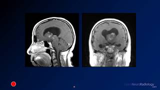 Neuroradiology board review 3 case 1 [upl. by Yriek]