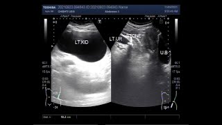 Fate of kidney in case of untreated ureteral stone [upl. by Guimond129]