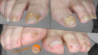 Treating complicated nails and improving their appearance through integral podology [upl. by Raseda]