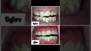 Full Mouth Scaling and Root Planing scaling dentalappointments calculus removal [upl. by Kcirtapnhoj]