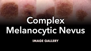 Complex Melanocytic Nevus Image Gallery [upl. by Oyek]