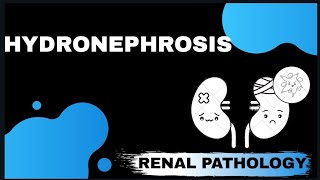 HYDRONEPHROSIS  Renal pathology   Med Bees [upl. by Arodoeht198]