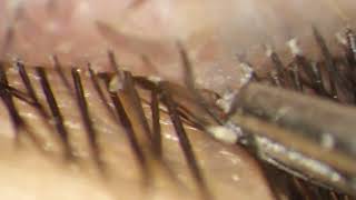 Removing Entire DEMODEX Mites hiding in eyelashes [upl. by Melina]